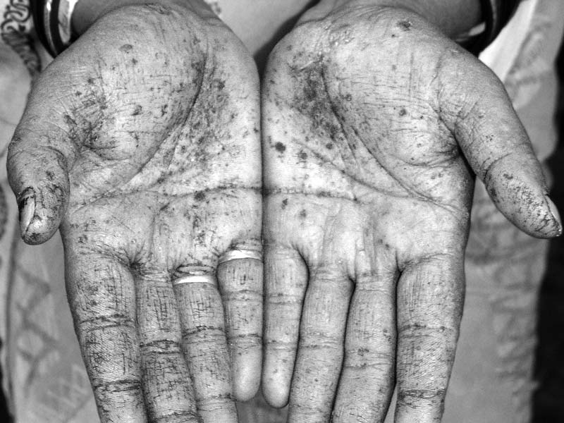Melano-keratosis in the hands of a lady dependent on arsenic-contaminated drinking water source in a village in Bhojpur district, Bihar